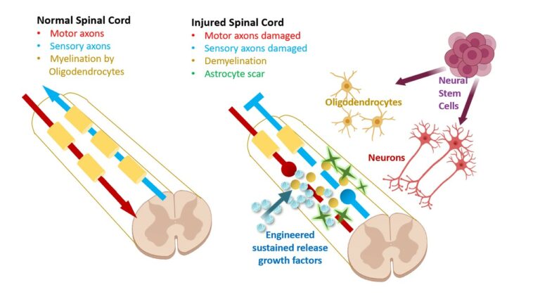 abbott primary cell spinal cord stimulation